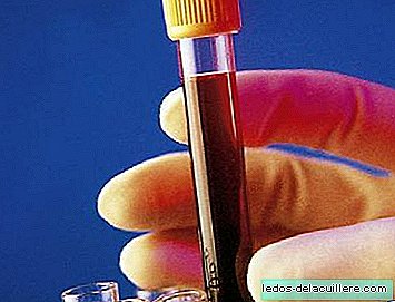 اختبارات الدم للكشف عن متلازمة داون دون مخاطر
