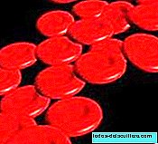 فقر الدم بسبب نقص الحديد