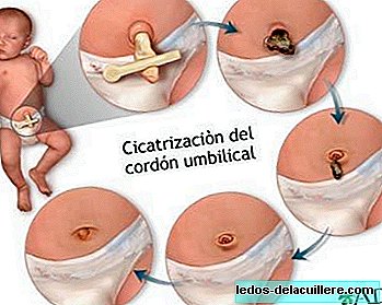 Abnormalities in the navel of the newborn