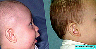 How to prevent plagiocephaly (deformity of the baby's head)