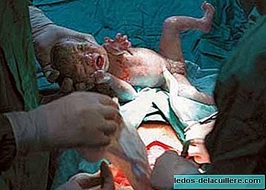 How is a cesarean section?