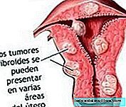 Complications in pregnancy due to fibroid tumors