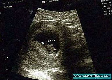 Sužinokite kūdikio lytį per pirmąjį ultragarsą