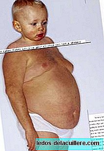 10% дітей у віці від 3 до 12 років страждають ожирінням
