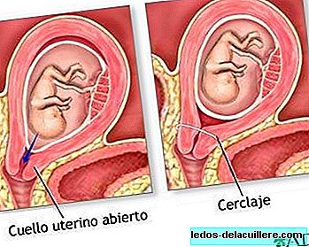 Uterine or cervical cerclage