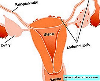 Endometrios påverkar 15% av spanska kvinnor i fertil ålder