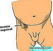 Inguinale hernia