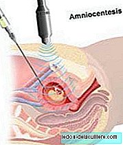 The risks of amniocentesis
