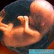 Bebê nasce com o feto de seu irmão dentro
