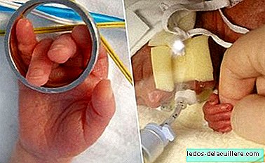 26 सप्ताह के गर्भ के जुड़वाँ बच्चे पैदा होते हैं