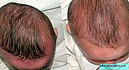 Plagiocephaly, more signatures are needed