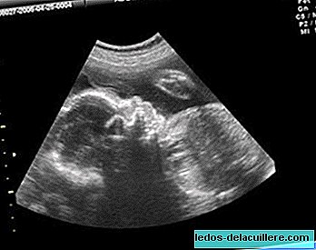 Prenatal test I: ultraljud