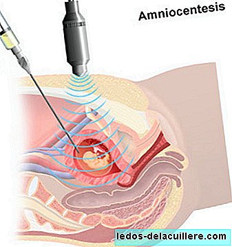 Prenatal tests II: Amniocentesis