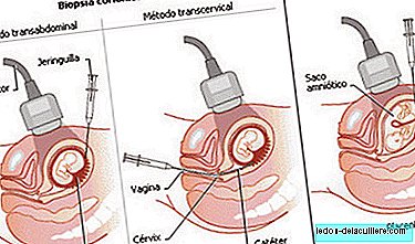Prenatal V-test: Chorionisk biopsi