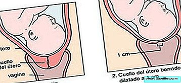 O que é o apagamento cervical?