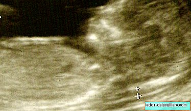 What is the measurement of the nuchal fold?