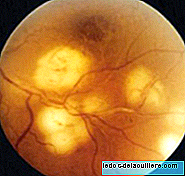 Retr-cam, zdjęcia oczu wcześniaków, które pozwalają zwalczyć ślepotę