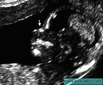 Software om het syndroom van Down te detecteren in het eerste trimester van de zwangerschap
