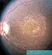 Genų terapija, skirta gydyti vaikų aklumą, kurį sukelia įgimta Leberio amaurozė