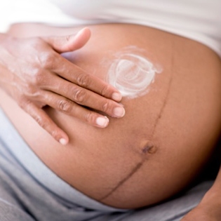 Alterações da pele durante a gravidez (vídeo)