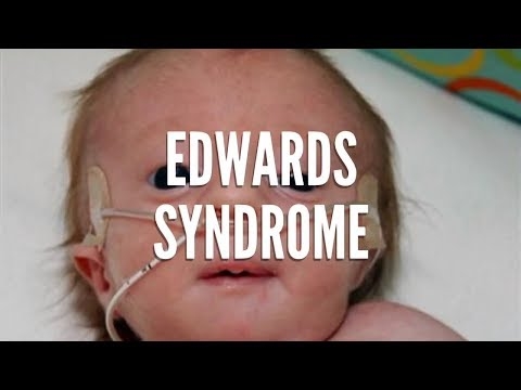 Um bebê com síndrome de Edwards que viveu apenas dez dias cercado pelo amor de sua família