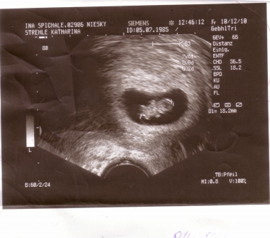 4D Ultraschall eines 11 Wochen alten Babys