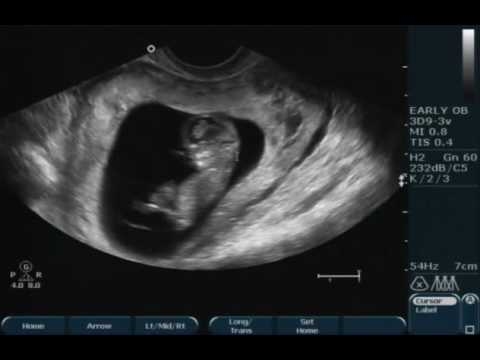 4D ultrasound of an 11-week-old baby