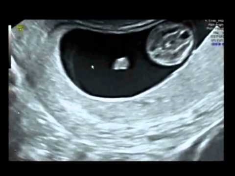 אולטרסאונד 4D של תינוק בן 11 שבועות