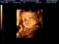 4D echografie van een baby van 11 weken oud