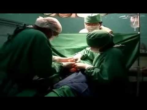فيديو: ولادة توائم بعملية قيصرية