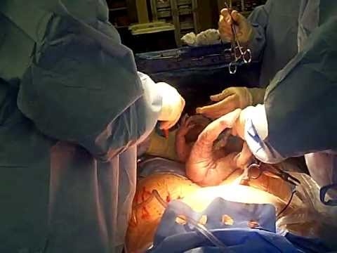 Video: birth of twins by caesarean section