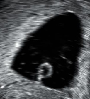 Анембрионална бременност