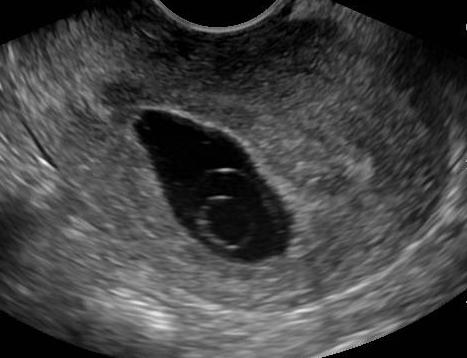 Anembryonic pregnancy