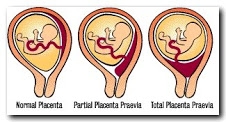 Placenta-planeetta