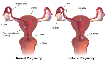Symptomer på ektopisk eller ekstrauterin graviditet