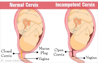 Causes and symptoms of incompetent cervix