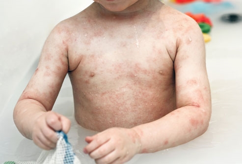 L'enfant atteint de dermatite atopique: un aperçu