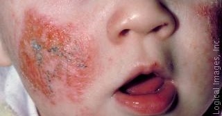 Anak dengan dermatitis atopik: gambaran umum