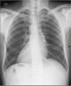 What is inverted heart syndrome or dextrocardia?
