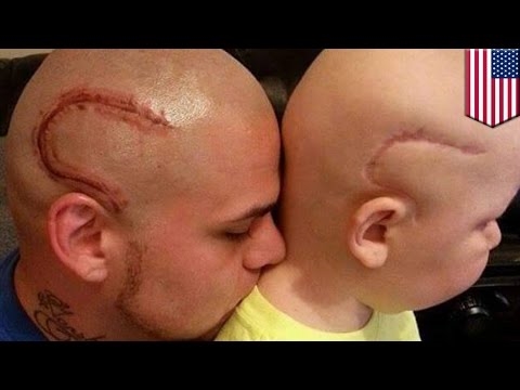 Un tatuaggio è fatto proprio come la cicatrice di tuo figlio, operato dal cancro al cervello