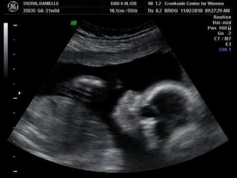 Schwangere Drillinge erhalten einen Live-Ultraschall, um herauszufinden, wie viele Babys sie haben werden