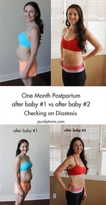Diastasis après la grossesse (vidéo)