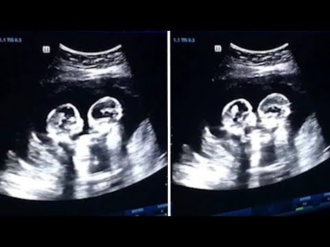 Kuinka kaksi kaksoset näyttävät vatsasta ja miten vauvat syntyvät MRI: llä