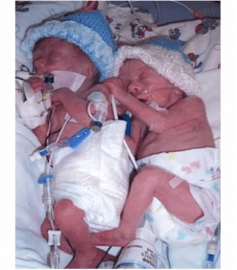 Cum arată doi gemeni în burtă și cum se nasc bebelușii pe un RMN